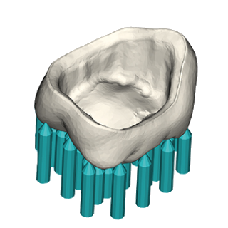 hyperDENT Sintered Dental Coping