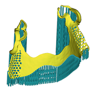 hyperDENT Additive Sintered Partial Framework